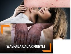 CDC Mengeluarkan Panduan Hubungan Seks Agar Tidak Terkena Cacar Monyet