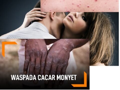 CDC Mengeluarkan Panduan Hubungan Seks Agar Tidak Terkena Cacar Monyet