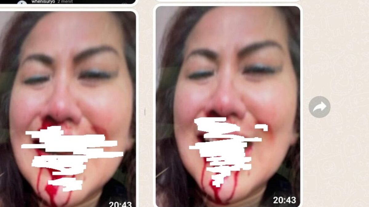Artis Venna Melinda Foto Hidungya Berdarah Sembari Menyeringai Beredar Viral Artis Venna Melinda Foto Hidungya Berdarah Sembari Menyeringai Beredar Viral