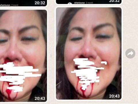 Artis Venna Melinda Foto Hidungya Berdarah Sembari Menyeringai Beredar Viral